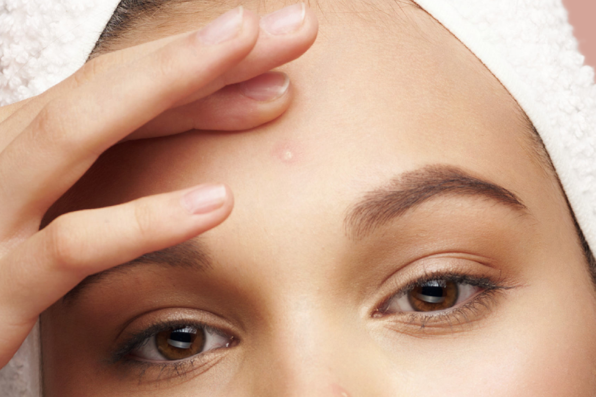 What Causes Forehead Acne? (& How to Solve It)