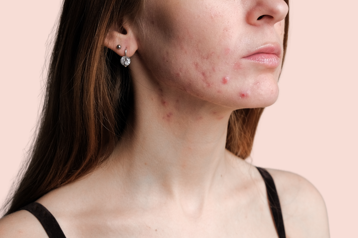 Dry Acne-Prone Skin? This May Be Why (+ How to Fix It)