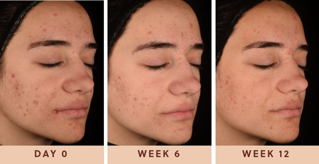 Image showing improved clear skin results after using Glow Biome from day one to week twelve				