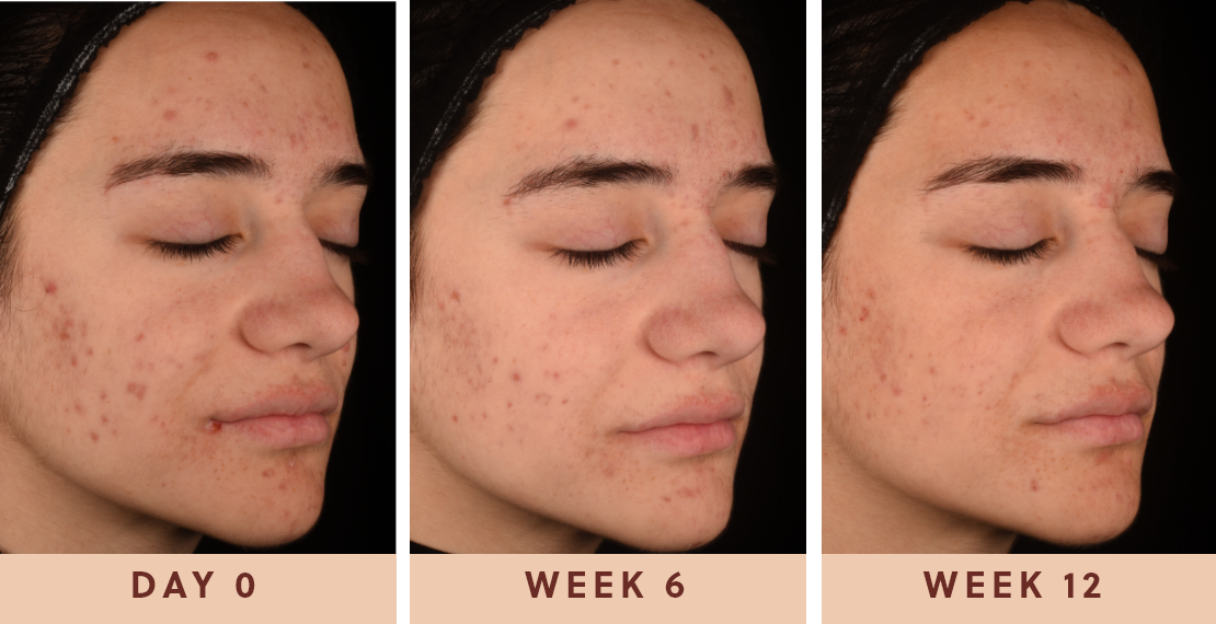 Image showing improved clear skin results after using Glow Biome from day one to week twelve