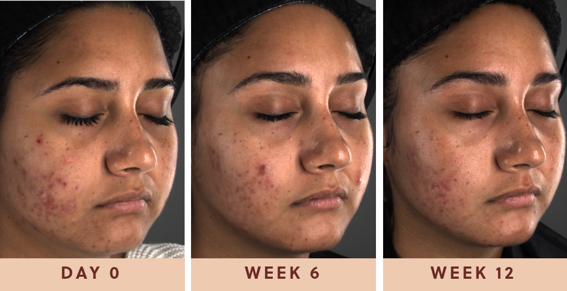 Image showing improved clear skin results after using Glow Biome for gut and skin health from day one to week twelve