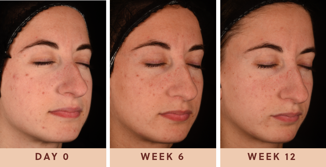 Image showing improved clear skin results from taking Glow Biome skin probiotic supplements for 12 weeks
