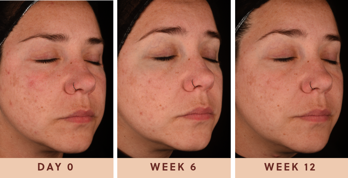 Image showing improved clear skin results after using Glow Biome from day one to week twelve