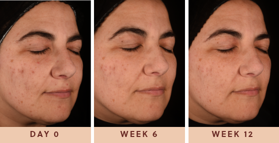 Image of woman showing incredible results after using Glow Biome from day 0 to 12 weeks after