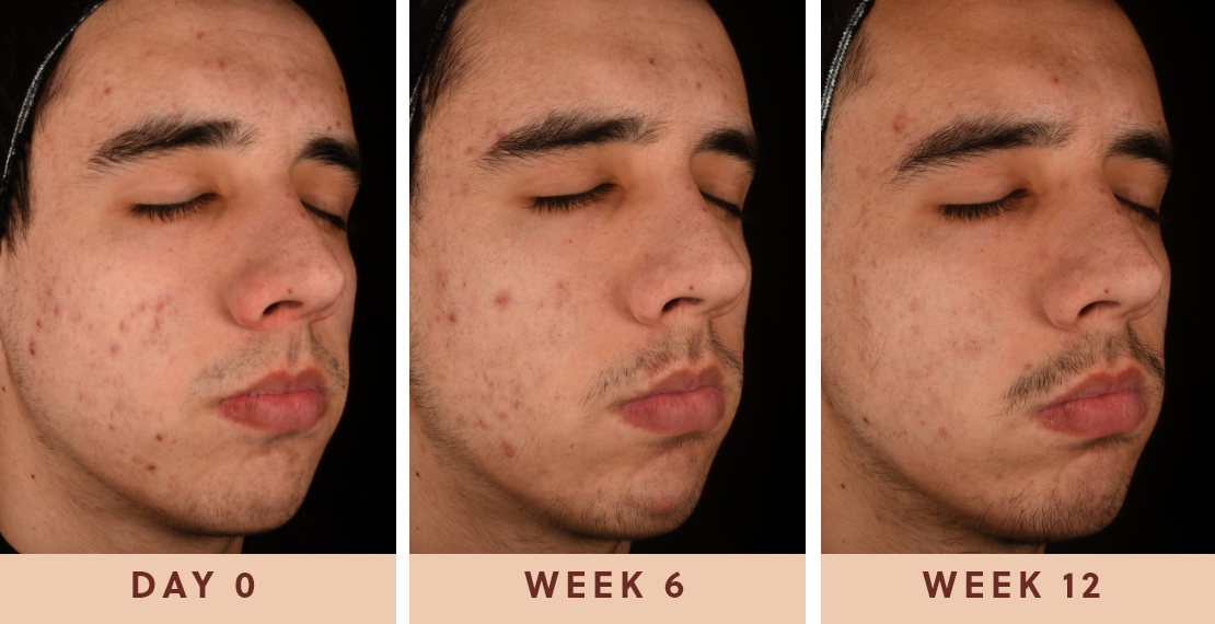 Image showing improved clear skin results after using skin probiotics for skin and gut health from day one to week twelve