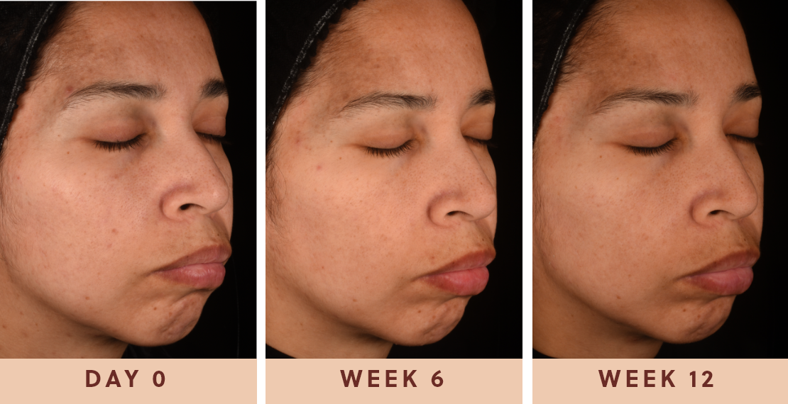 Image showing improved clear skin results from taking Glow Biome skin probiotic supplements for 12 weeks