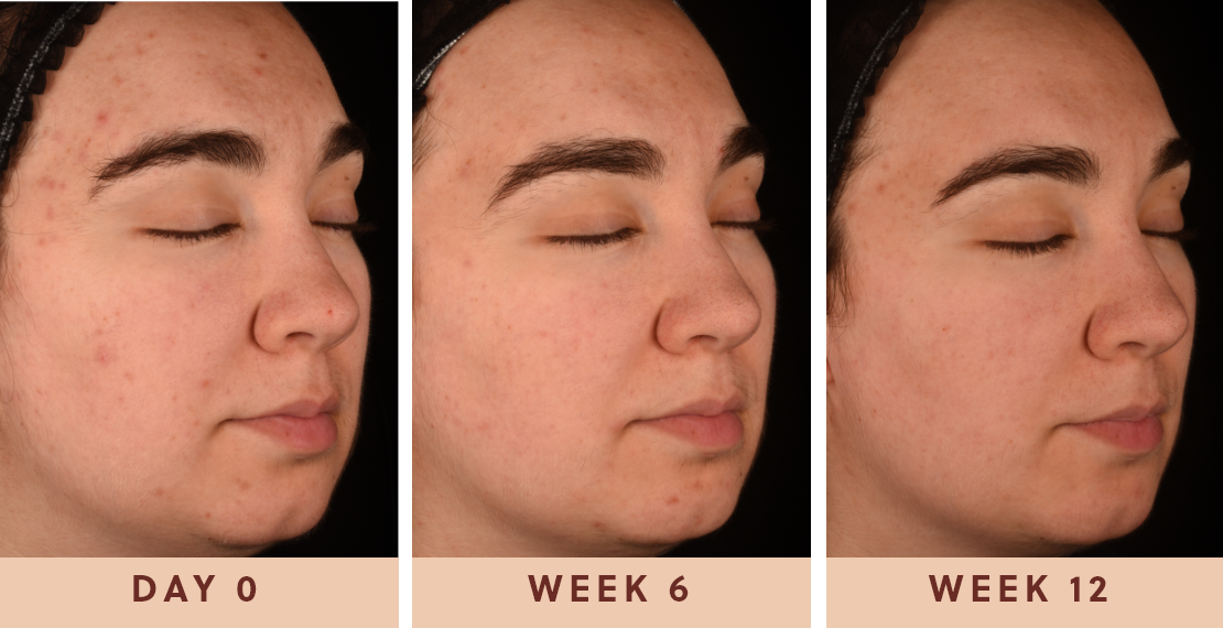 Image showing improved clear skin results from taking Glow Biome skin probiotic supplements for 12 weeks