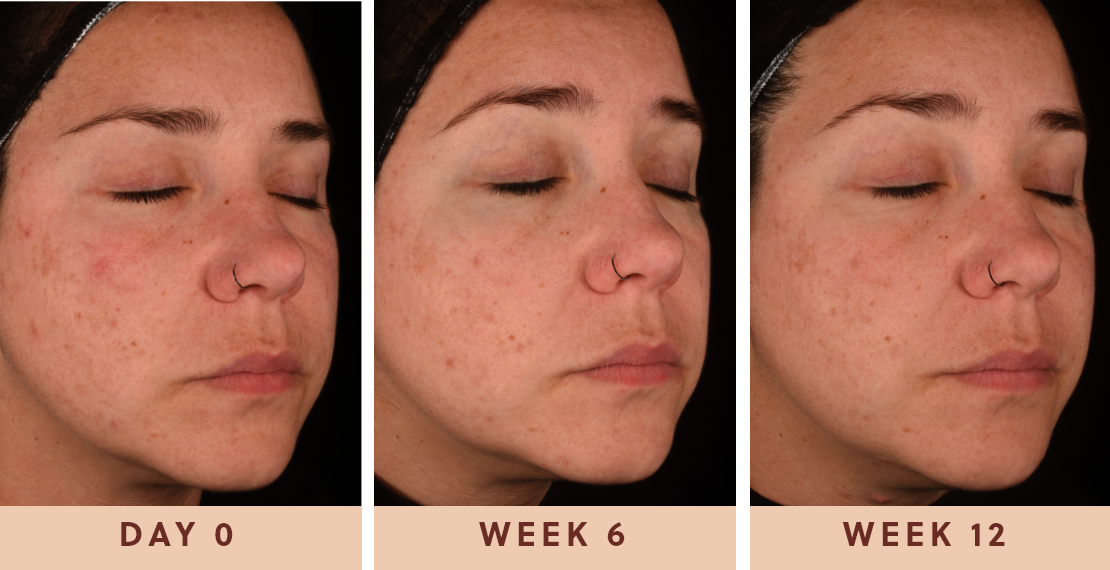 Image showing improved clear skin results after using Glow Biome from day one to week twelve				