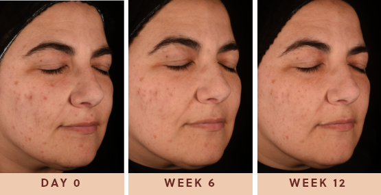 Image of woman showing incredible results after using Glow Biome from day 0 to 12 weeks after				