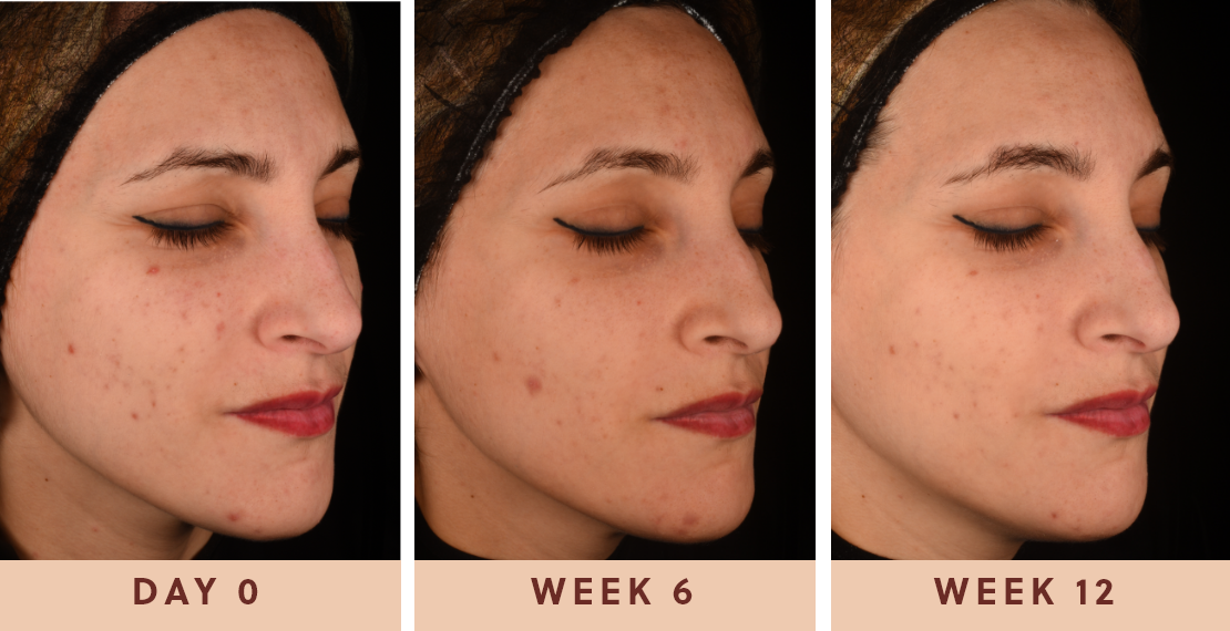 Image showing improved clear skin results from taking Glow Biome skin probiotic supplements for 12 weeks