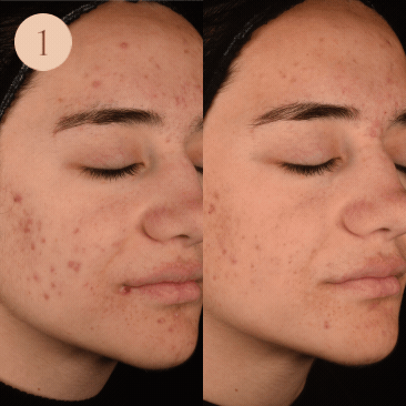 gif of clear skin results after using Glow Biome skin probiotics