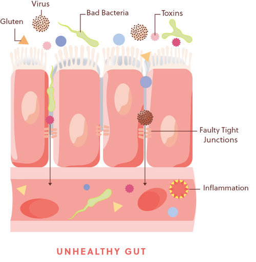 Graphic displaying what an unhealthy gut looks like.